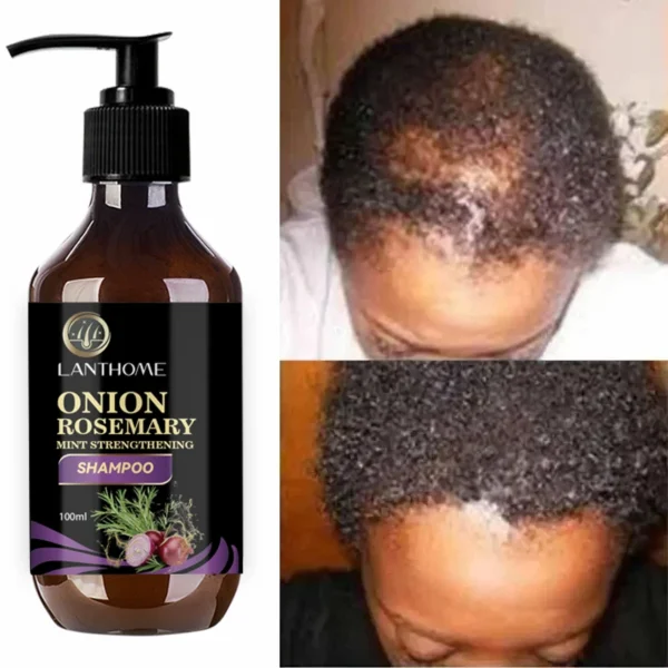 Hair Shampoo For Fast Hair Growth Rosemary Onion Hair Regrowth Shampoo Anti Hair Loss Effective Within 7 Day Hair Care Product - Image 4